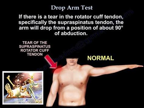 drop arm rotator cuff injury test|rotator cuff tear physical exam.